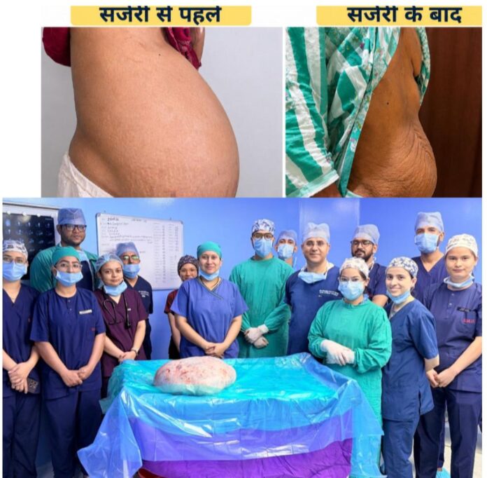 श्री महंत इन्दिरेश अस्पताल के कैंसर सर्जरी विभाग के डॉक्टरों ने एक 51 वर्षीय महिला के पेट से 15 किलो का ओवेरियन (अंडाशय) ट्यूमर सफलतापूर्वक निकालकर उसे नई ज़िंदगी दी